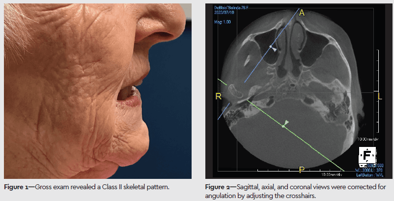 prexcbct01.png